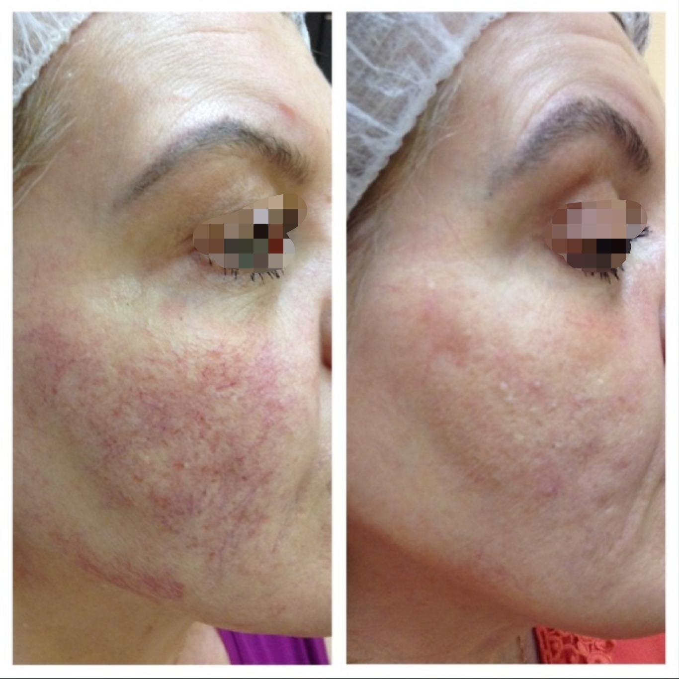 Фотоомоложение лица: описание и стоимость в Санкт-Петербурге