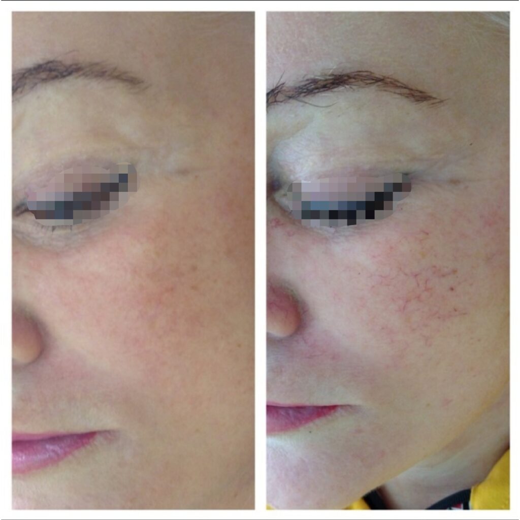 Фотоомоложение лица: описание и стоимость в Санкт-Петербурге